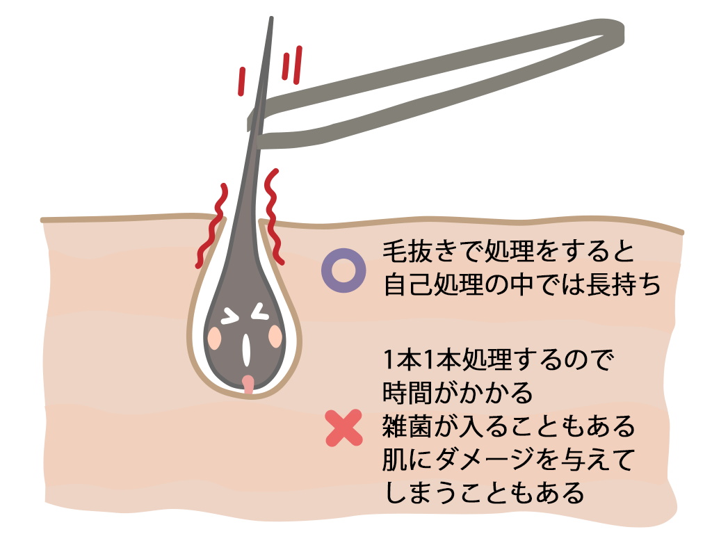 陰毛 毛抜き